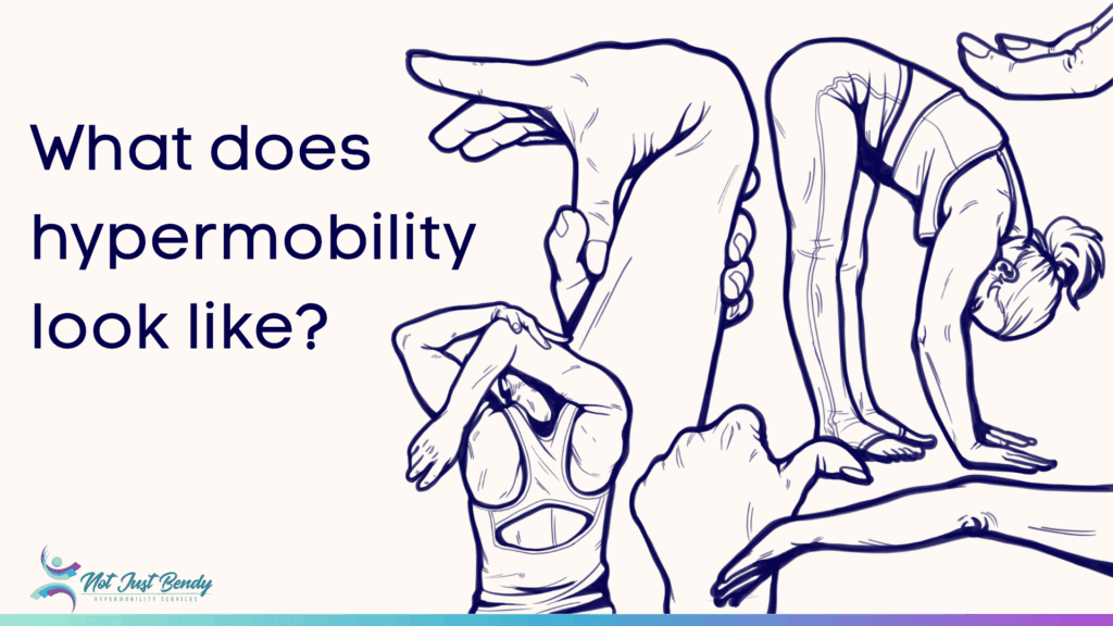 Illustrations of common signs of joint hypermobility, including flexible thumbs, arms, and spine in various postures